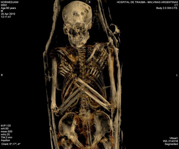 Imágenes de tomografía que dejan ver los huesos de la momia, tomadas en 1980 por Sonia Lesyk y González Toledo. Foto: gentileza.